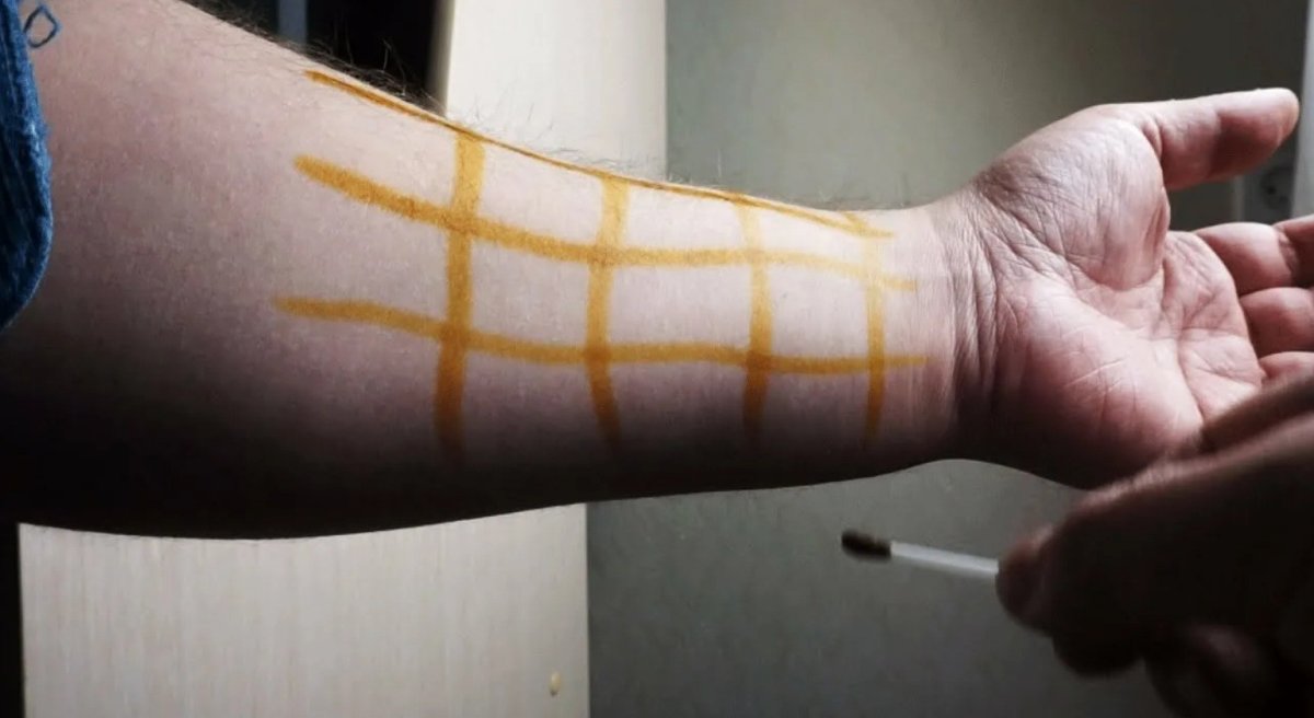 йодная сеточка на руке